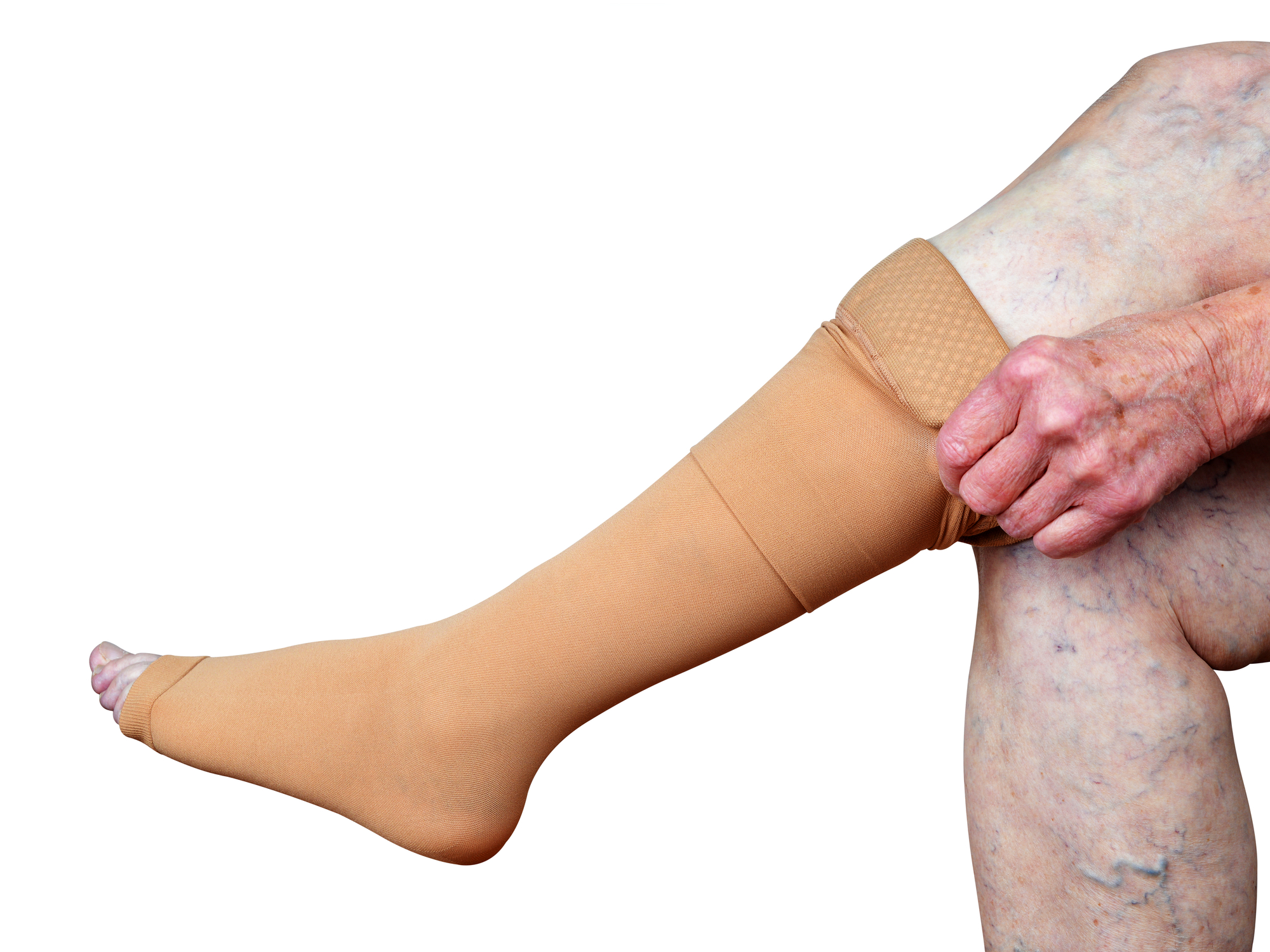 a woman puts a compression stocking on her leg with varicose veins