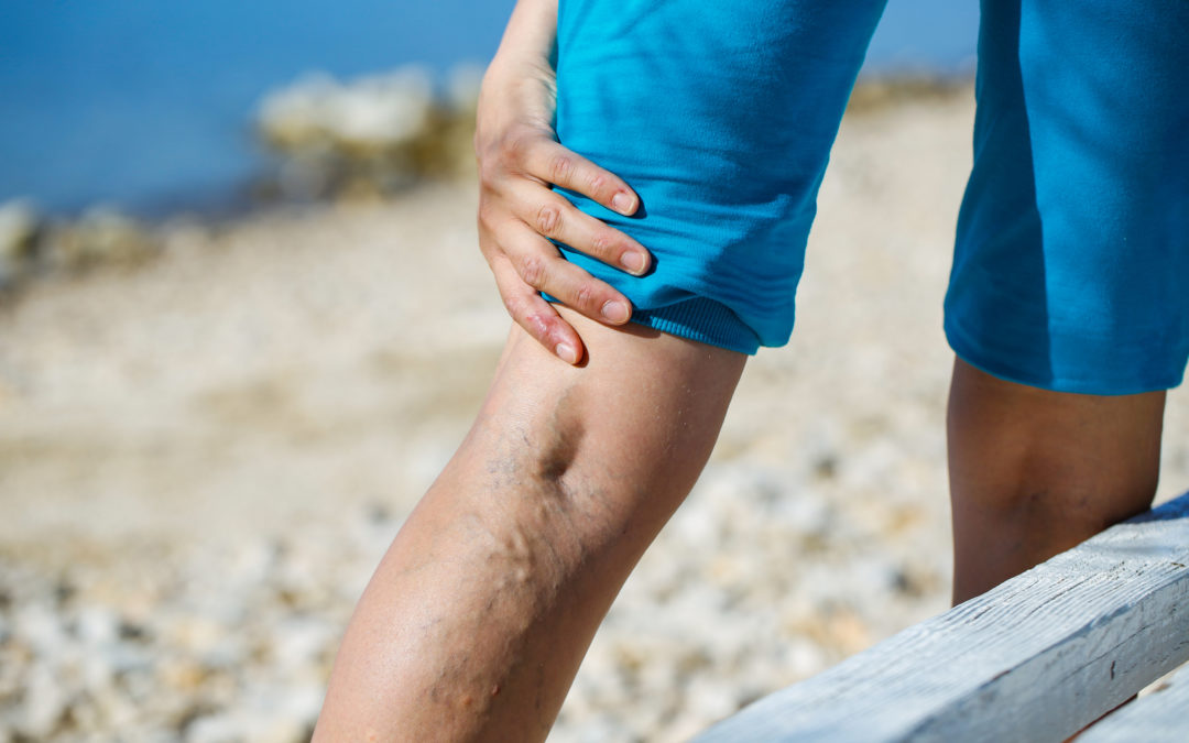 Living With Varicose Veins